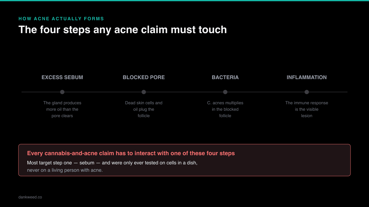 Diagram of how acne forms: sebum production, a blocked pore, bacterial growth and the resulting inflammation.